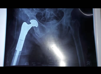 xray of a successful Total Knee Replacement